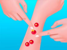 Pimple Poper Rush