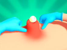 Pimple Squeeze